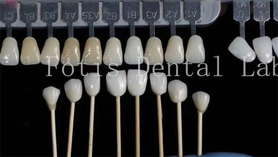 কাস্টমাইজেশন প্রাকৃতিক দাঁত veneers ভুয়া দাঁত overlays উচ্চ শক্তি