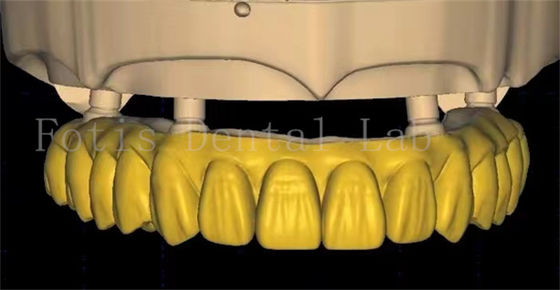 OEM ডেন্টাল ক্রোন ডিজাইন উন্নত স্ক্যানিং এবং 3 ডি প্রিন্টিং প্রযুক্তি ব্যবহার করে